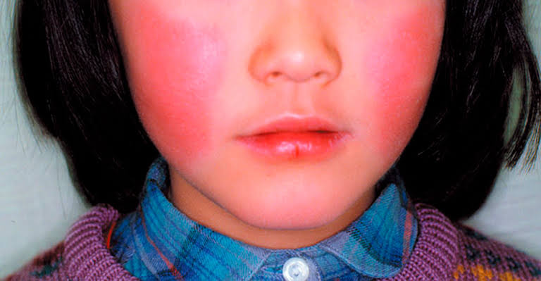fifth-disease-red-cheek