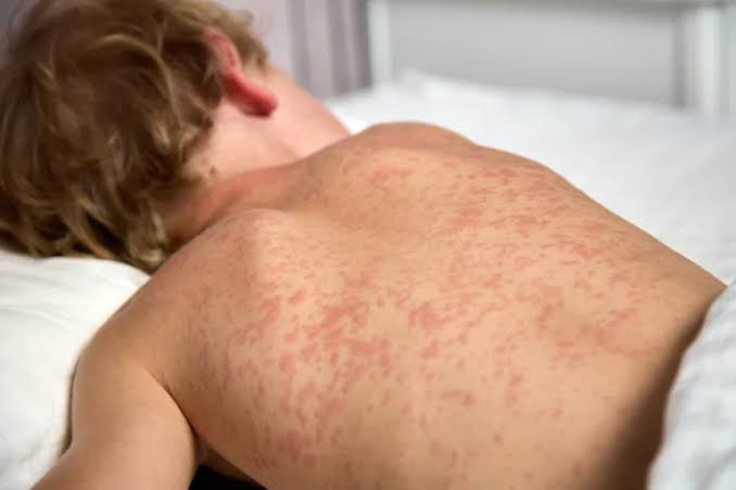 roseola-infantum